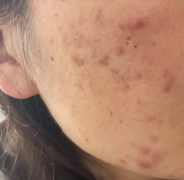 夏季出油皮肤总冒痘？Stridex 施颜适水杨酸棉片来拯救，助你养出好肌肤！	